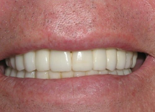 Englewood Dental Implant After 1.2
