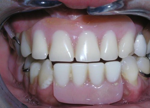 Englewood Dental Implant After 2.1