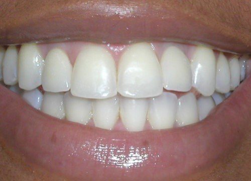 Englewood Dental Implant After 4