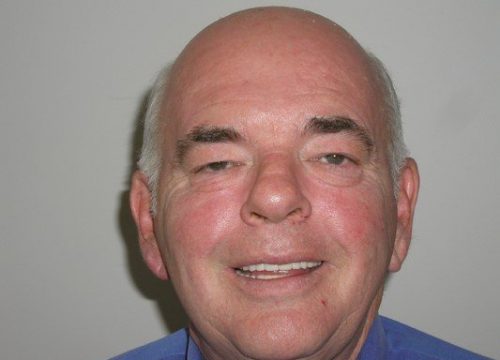 Englewood Dental Implant After Patient 1