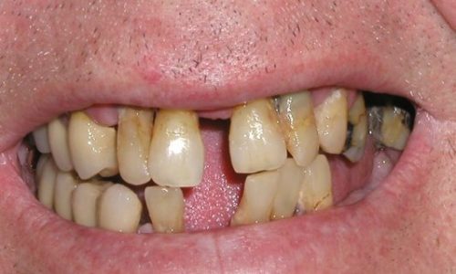 Englewood Dental Implant Before 1.2