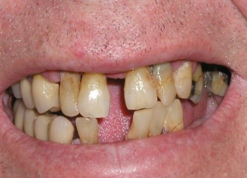 Englewood Dental Implant Before 1.2