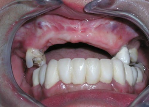 Englewood Dental Implant Before 2.1